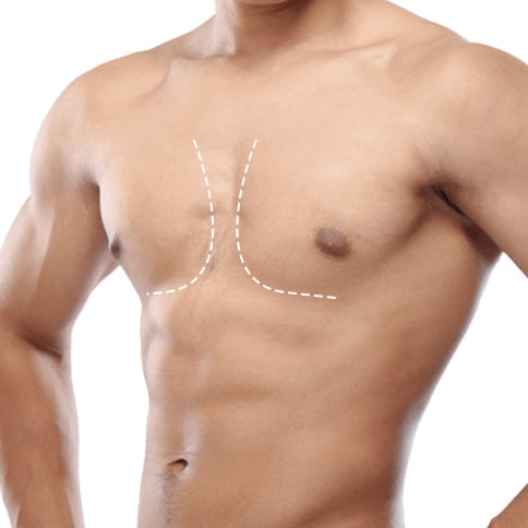 Gynaecomastia in�Noida