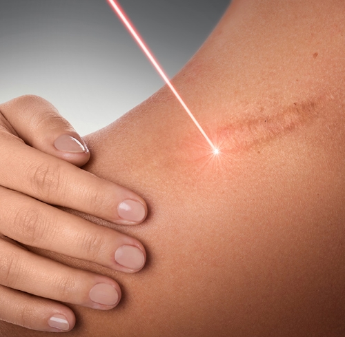 Keloids Treatment in�Noida