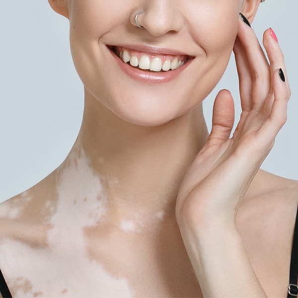 Vitiligo Treatment in�Noida